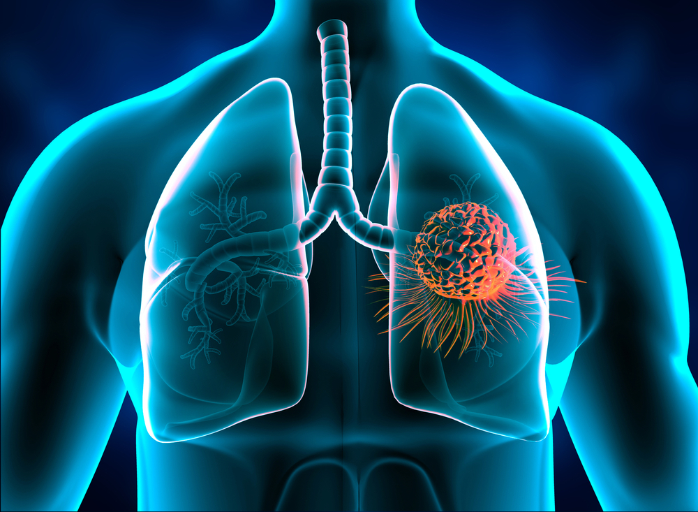icd-10 code for lung cancer