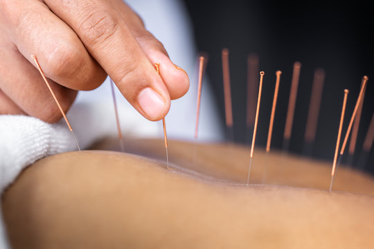 Expert Acupuncture Billing Services: Essential Questions And Answers Professional Acupuncturist Performing Needle Therapy Treatment Requiring Expert Acupuncture Billing Services For Proper Insurance Claim Processing