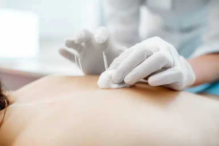 Expert Acupuncture Billing Services: Essential Questions And Answers Licensed Acupuncturist Providing Therapeutic Needle Treatment With Expert Acupuncture Billing Services Ensuring Accurate Medical Coding And Reimbursement