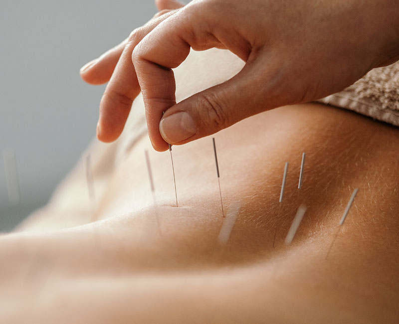 Trusted Acupuncture Billing Services For Quick Payments Professional Acupuncture Treatment With Precise Needle Placement Requiring Trusted Acupuncture Billing Services For Accurate Medical Coding And Quick Payments